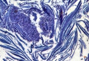 M,68y. | auditory meatus … otitis externa mycotica - (toluidine-blue- stained semithin section)